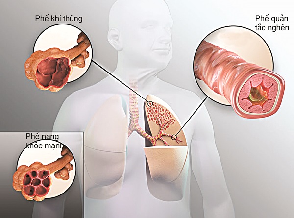 bệnh phổi tắc nghẽn mạn tính